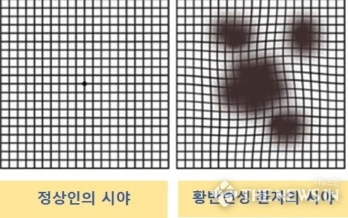 정상인과 황반변성환자의시야 (1)