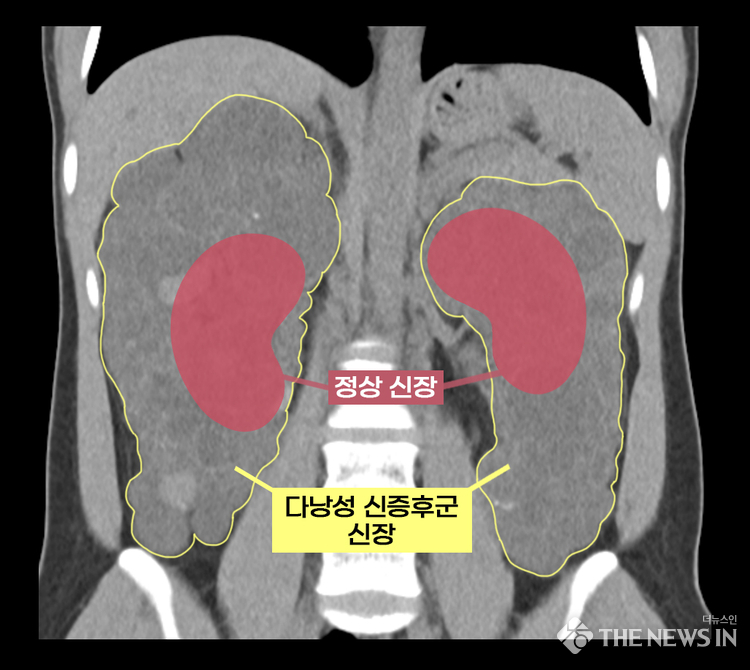 실제 다낭성 신증후군 환자의 신장과 정상 신장 비교(수많은 낭종으로 울퉁불퉁하고 크기도 비대해진 상태)<br>
